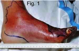 gout-symptoms-foot.jpg