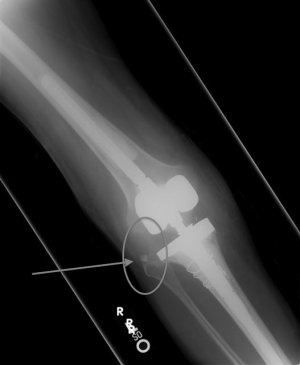 5th artificial joint w:wire-03.jpg