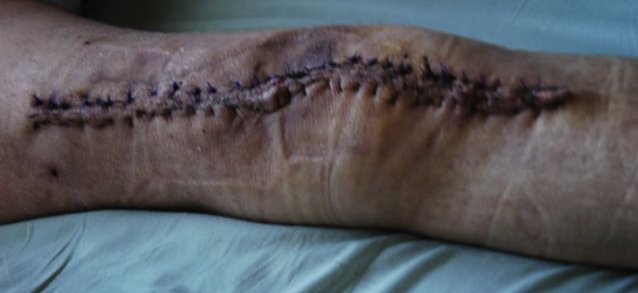 Kevin right knee post infection 2006.jpg