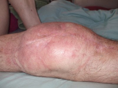 Knee sweling:infected-01.jpg